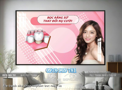 file tranh nha khoa implant boc rang su