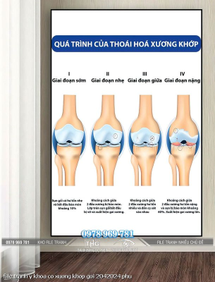 file tranh y khoa co xuong khop goi 2042024 phu