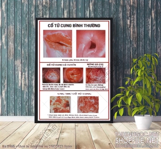 file tranh y khoa tu cung phu nu 29032023