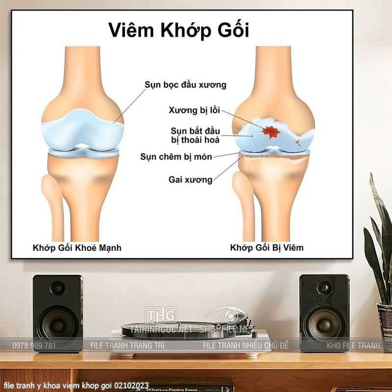 file tranh y khoa viem khop goi 02102023